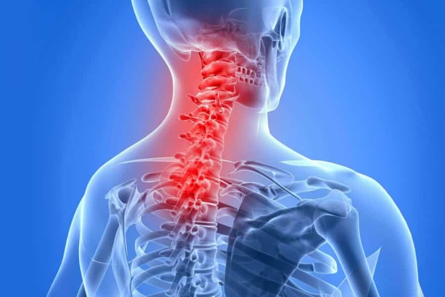 ankylosingspondylitis