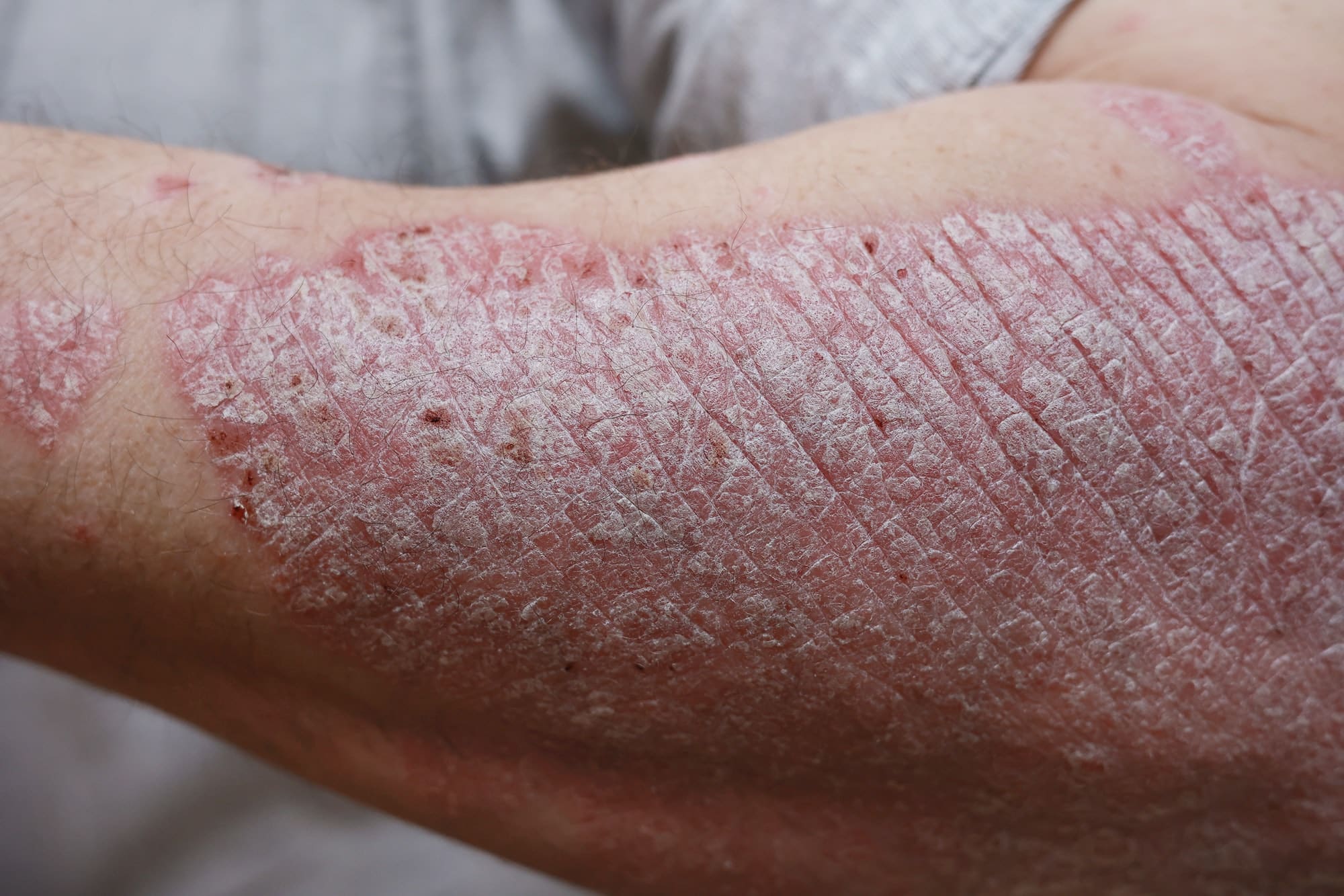 Close up, macro of psoriasis skin, autoimmune disease that affects the skin cause skin inflammation