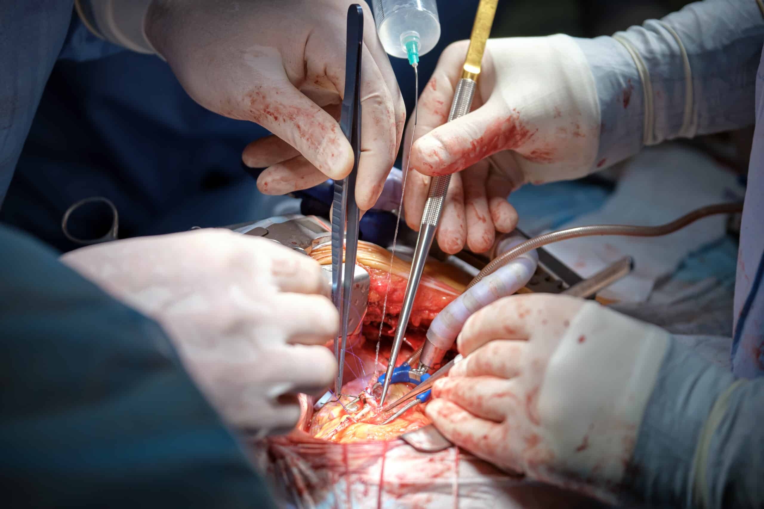 Closeup of professional doctor hands operating a patient during open heart surgery in surgical room