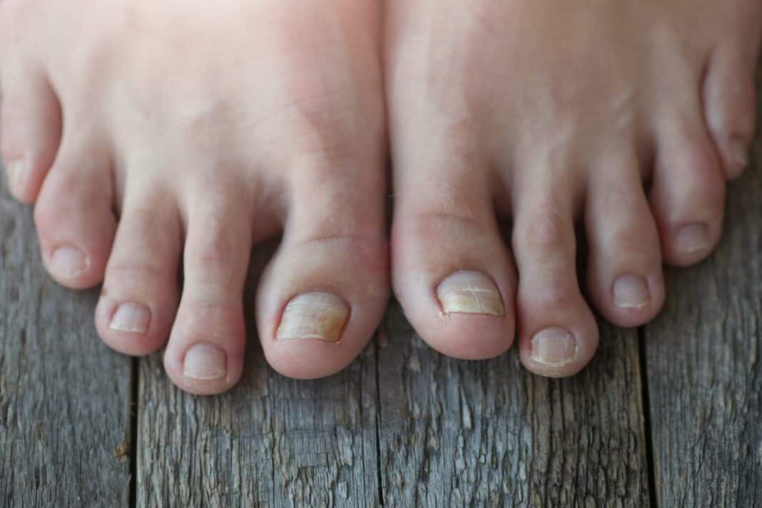 Onycholysis: exfoliation of the nail from the nail bed.