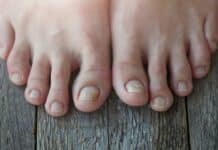 Onycholysis: exfoliation of the nail from the nail bed.