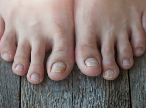 Onycholysis: exfoliation of the nail from the nail bed.
