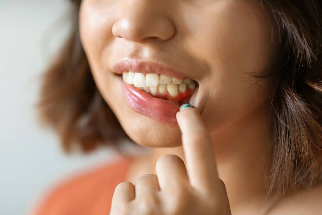 Δόντια: Πώς η ουλίτιδα συνδέεται με τη ΧΑΠ